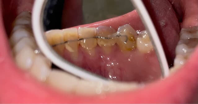 Is There a Warranty for Dental Implants in Northern Regions