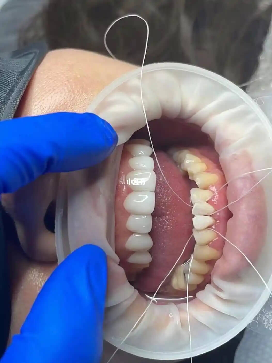 After getting dental implants in the north, you constantly feel like your teeth are pressing against the roof of your mouth. Could it be an issue with the placement