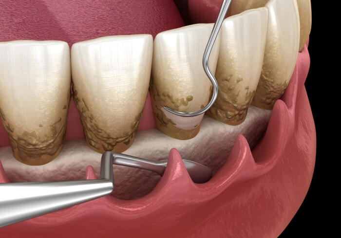 Which Dental Implant Clinics Are The Most Attentive in Beijing and Shanghai Latest Recommendations from Netizens
