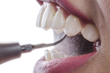 Is It Normal for Gaps to Widen Between Teeth After Getting Dental Implants in the North