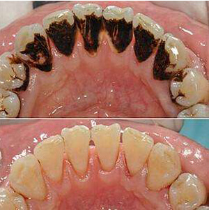 After traveling north for dental implants, why does my gum feel prickly all the time