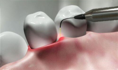 Do I need a special procedure for teeth cleaning after getting dental implants in the North