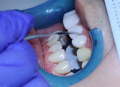 Will Wearing a Mask After Getting Dental Implants in the North Cause Inflammation