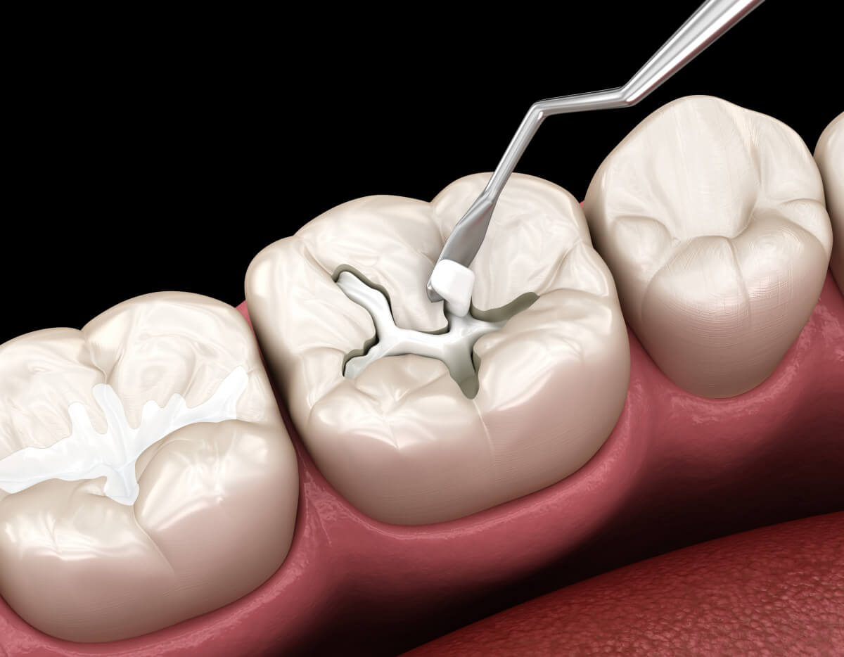 Is hardened gum after dental implantation in the back teeth a sign of bone growth