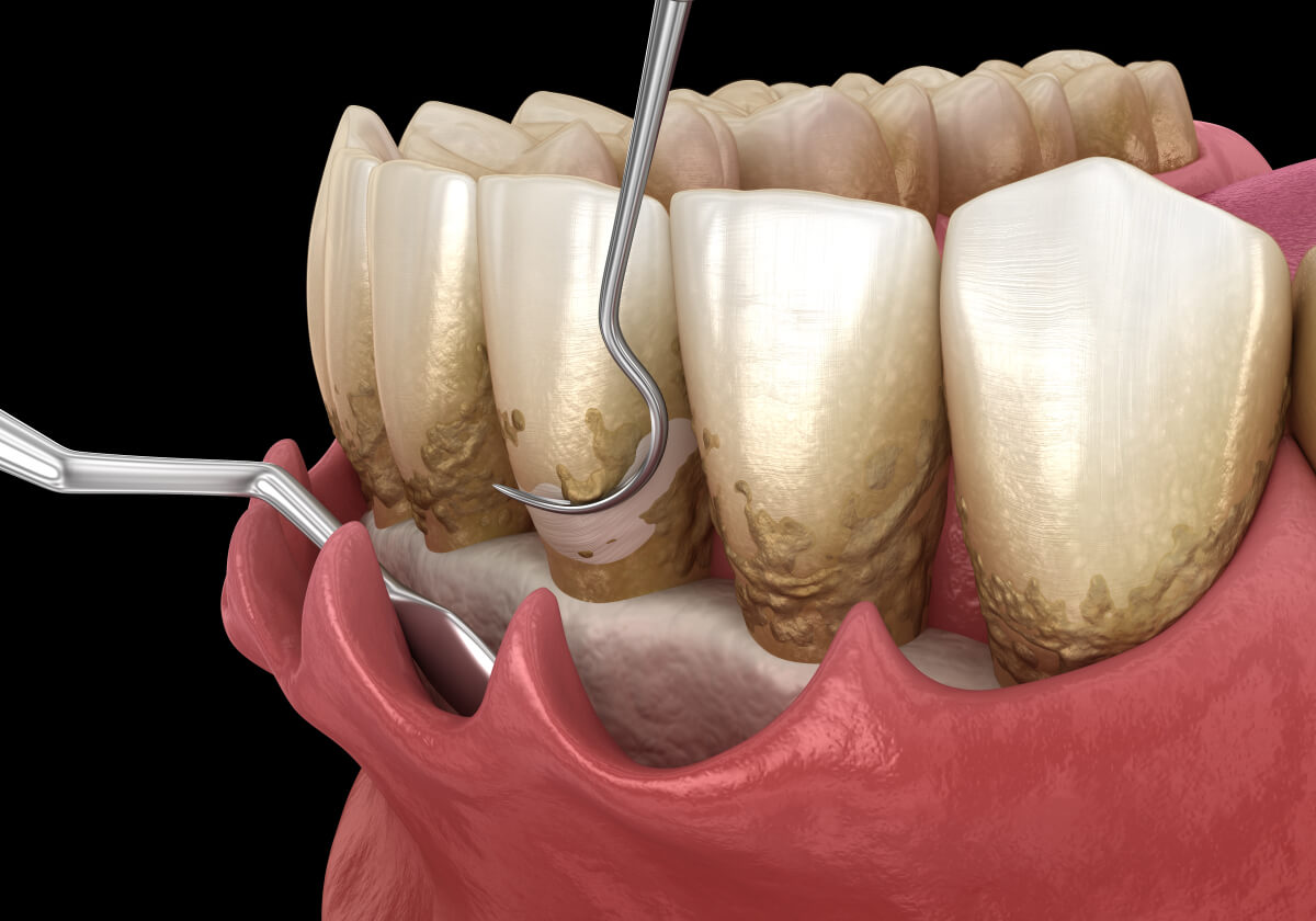 After getting dental implants in the north, do you constantly feel like somethings blocked