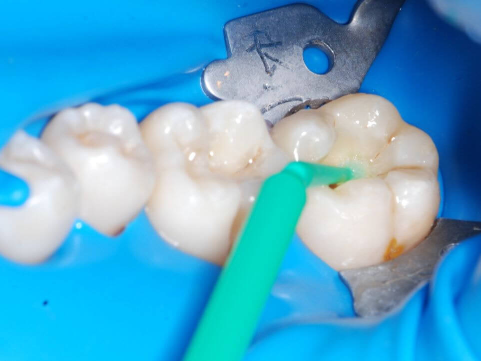 What to Do If Your Gums Turn Black After Getting Dental Implants in Northern Cities
