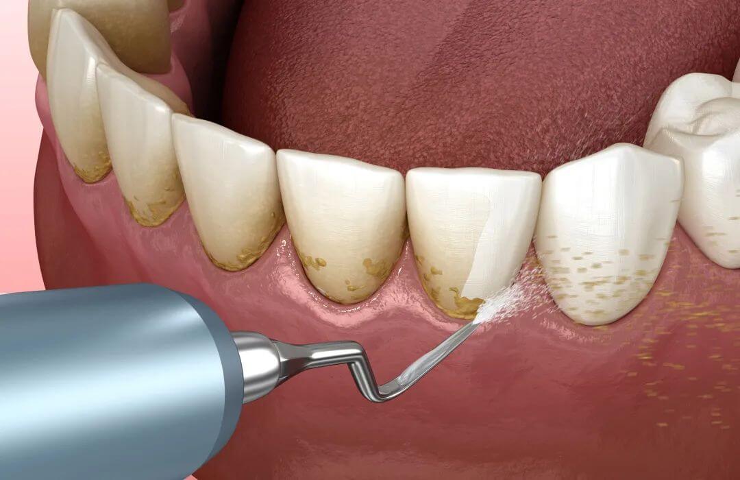 Is It Worth Getting Dental Implants in the North 2025 Latest Price Guide