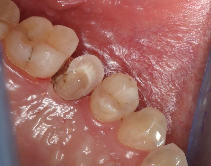 How to Manage Bad Breath When Wearing a Mask After Getting Implants in Beijing