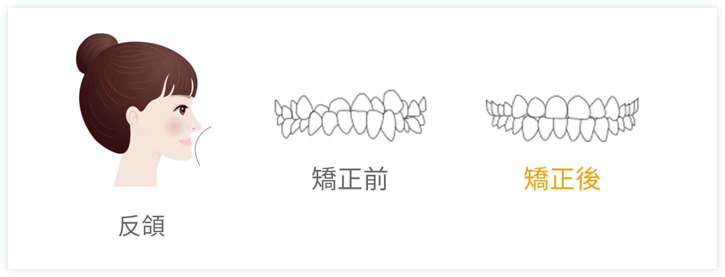 深圳牙齒矯正推介