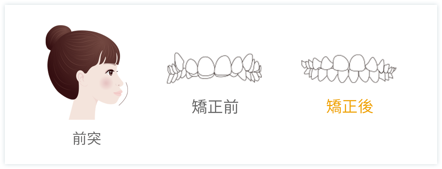 深圳牙齒矯正推介