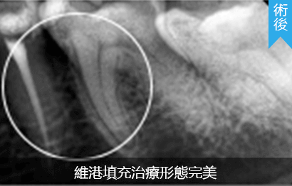 深圳根管治療收費