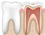 深圳牙髓炎治療