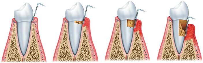 深圳牙周治療邊間好