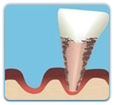 深圳牙根刮治收費