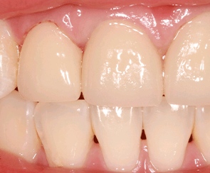 深圳牙根刮治費用