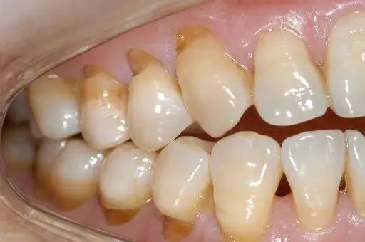 澳門牙醫科普：你們這不是在刷牙，而是“鋸牙”！