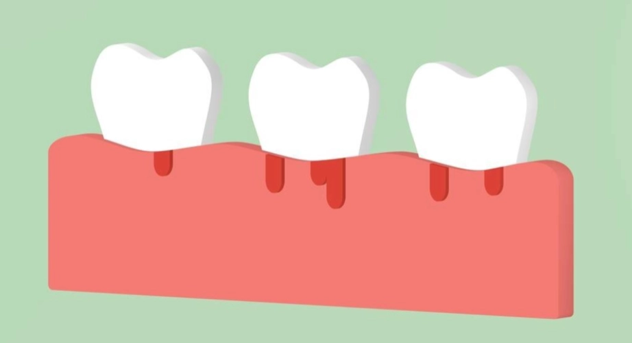 牙齒好好的，爲什麽用力一吸牙龈就出血？