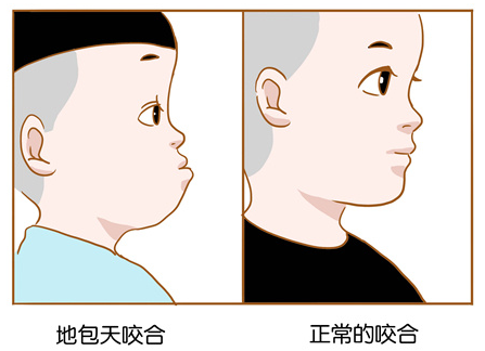 兒童牙齒“地包天”？盡早幹預矯正很關鍵