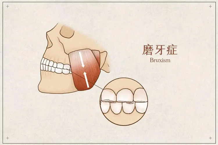 澳門牙醫為您介紹磨牙的危害與治療方法