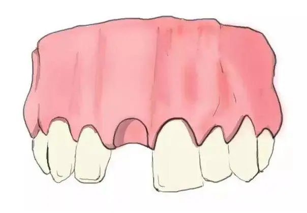 牙齒缺失了，三種修複手段，哪種會比較好？