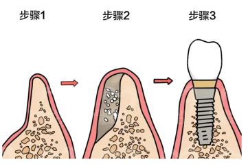 骨量不足還能種牙嗎？