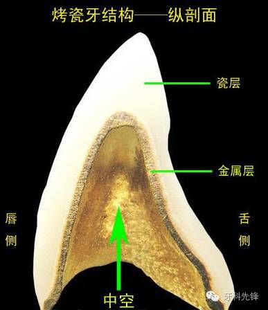 唔同種類嘅烤瓷牙價格與區別，你有必要了解