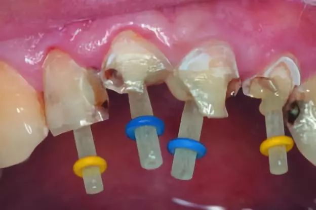 殘冠、殘根或者畸形牙治療後該如何選擇樁核材料？