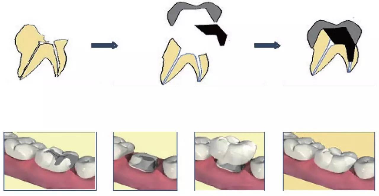 牙冠延長術步驟及案例講解