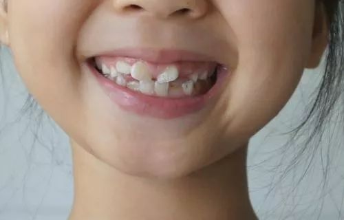 孩子新換的門牙出現鋸齒狀？長大了會消失嗎？