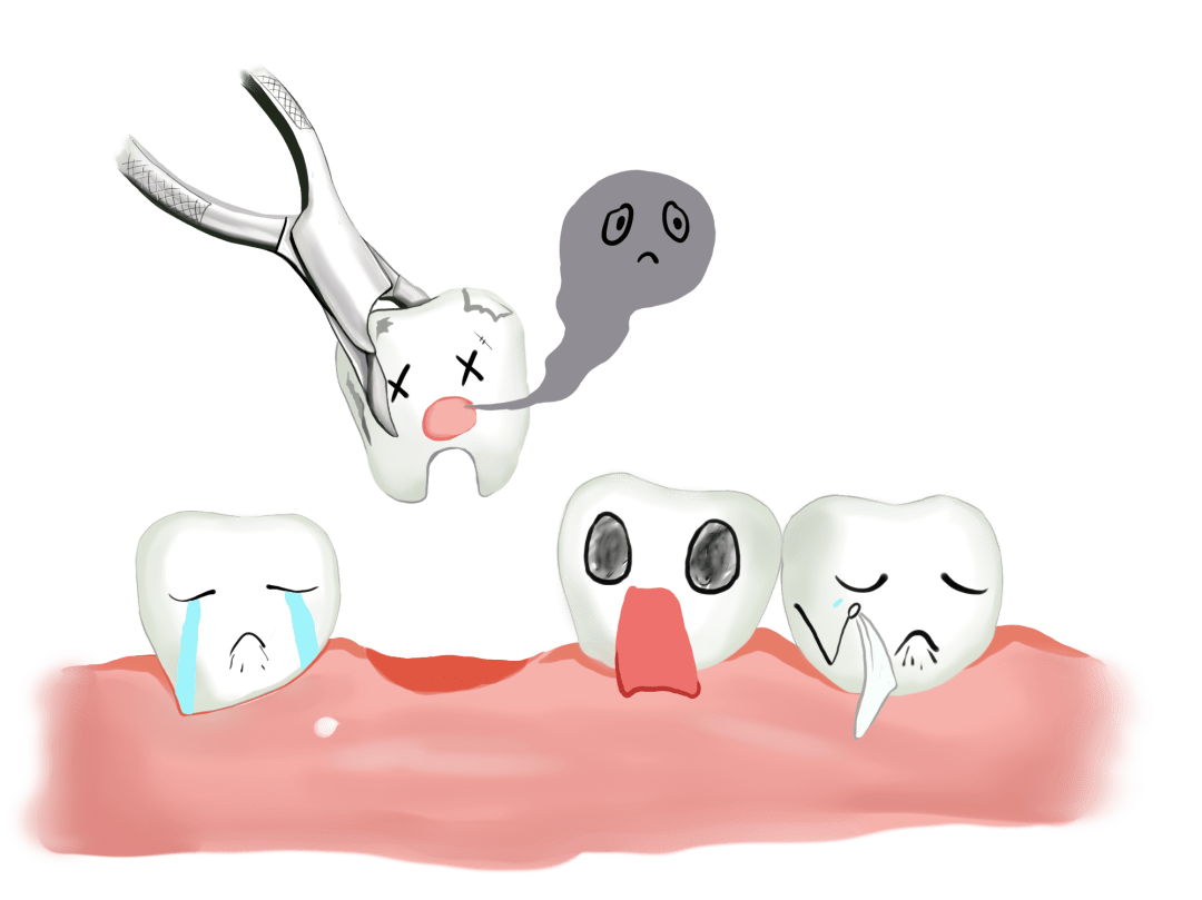 拔牙後嘅″血窟窿″點解長好嘅？明白之後再都唔使驚拔牙|澳門拔牙牙醫