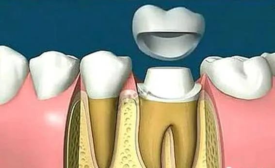 爲什麽醫生鑲一顆牙要磨兩邊嘅牙齒？