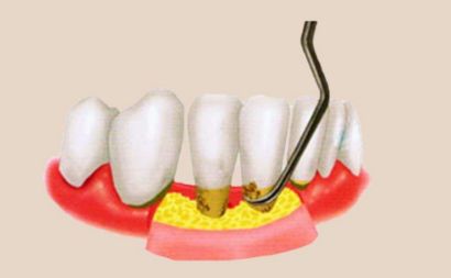 牙結石係點解會長喺牙龈底度？