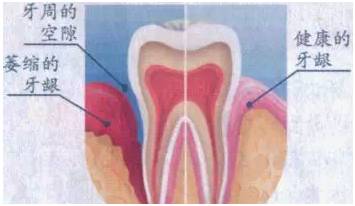 爲什麼牙齒容易鬆動？我們該如何應對？