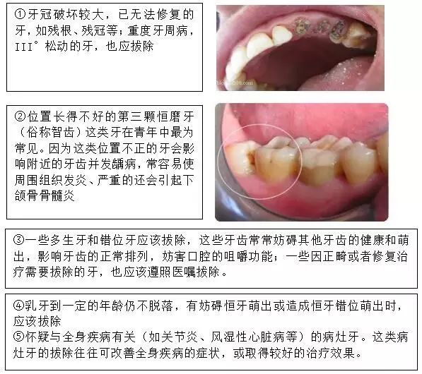 什麼樣的牙需要拔？牙齒摔斷了又該怎麼辦？