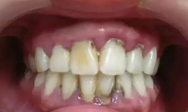 從不洗牙嘅人牙齒掉得快，仔細看完就明白了！