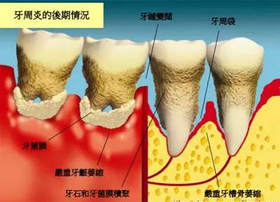 乳牙蛀牙嘅危害遠比我哋想像嘅更嚴重！