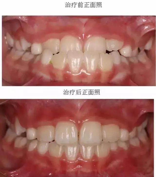 爲什麼很多家長都在給孩子使用MRC肌功能矯治器？