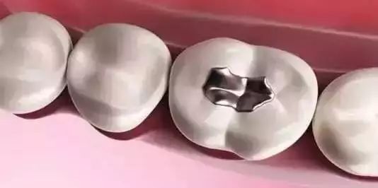同樣是補牙價格爲什麽差很遠？