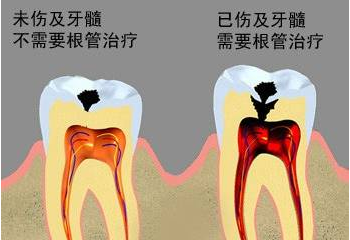 根管治療後建議做牙冠，選哪種比較合適？
